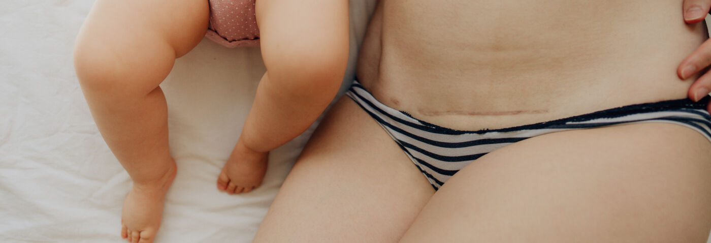 Cicatrice césarienne Cicatrice césarienne