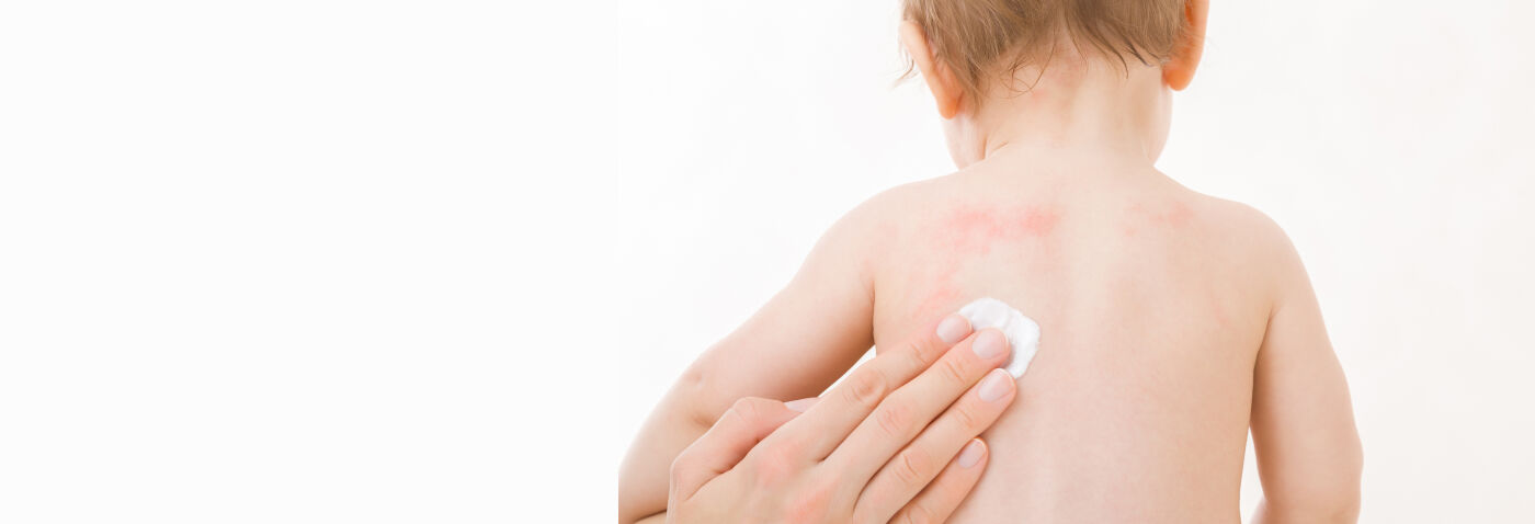 Psoriasis du bébé : les signes et comment soigner ? Psoriasis du bébé : les signes et comment soigner ?