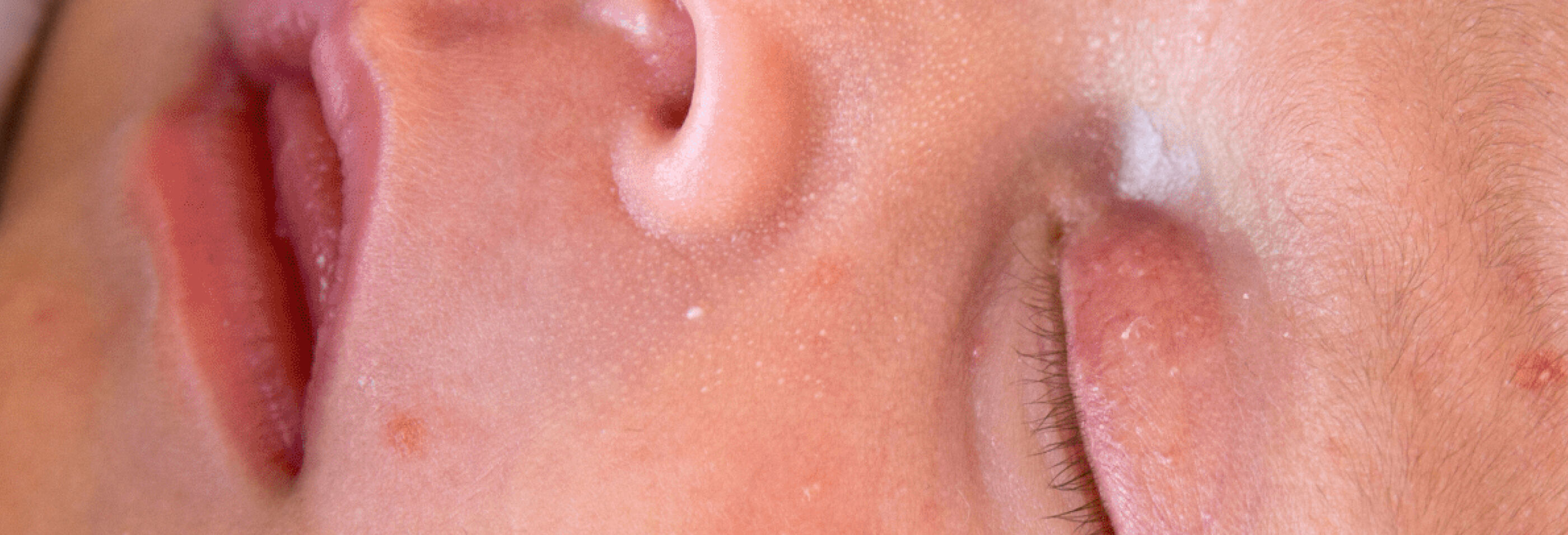 Boutons du nourrisson visage