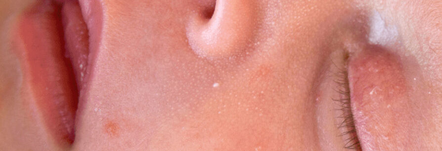 Boutons-nourissons-visage