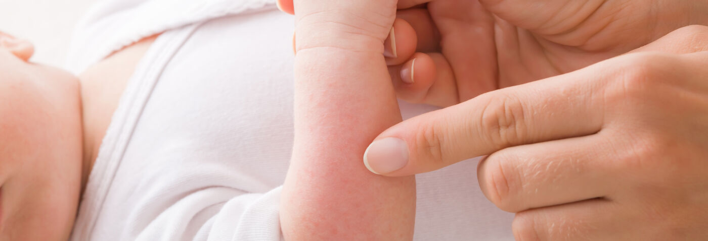 Soin de votre bébé : les bons gestes pour apaiser sa peau atopique